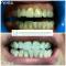 Trattamento di sbiancamento dentale laser